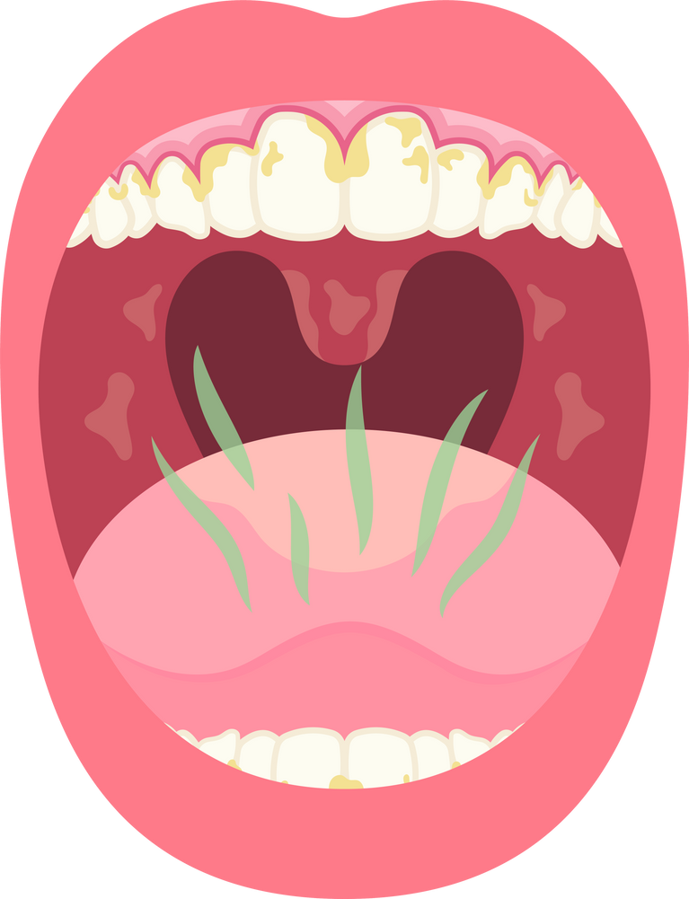 mouth oral halitosis hygiene dental health dry care gum disease tooth odor tongue tartar candidosis fungal cavities decay clean Tonsil stones bad breath gingivitis bacteria thrush plaque teeth