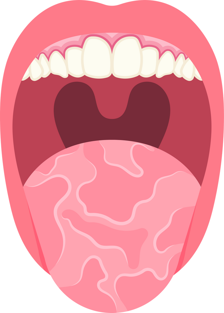 inflamed infection dry mouth candiasis oral yeast pain hygiene fungal Candidiasis papillae Geographic fissured thrush cancer candida bacteria glossitis vitamin deficiency Atrophic tongue swollen