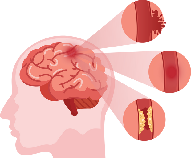Stroke disease. Hemorrhagic brain stroke concept. Apoplexy,